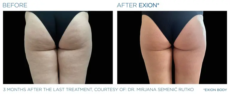 EXION result 3
