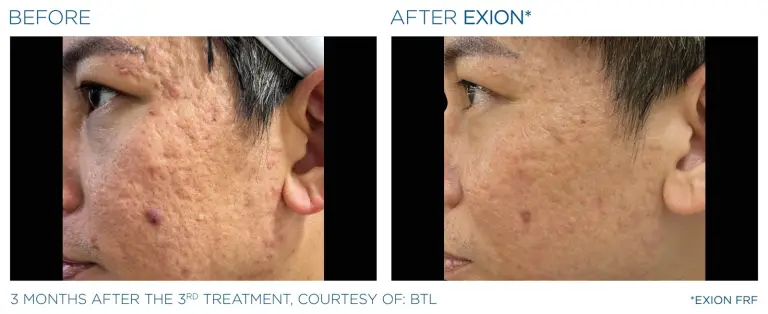 EXION result 5