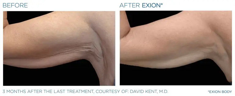 EXION result 6